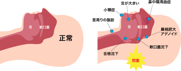 睡眠時無呼吸症候群の種類