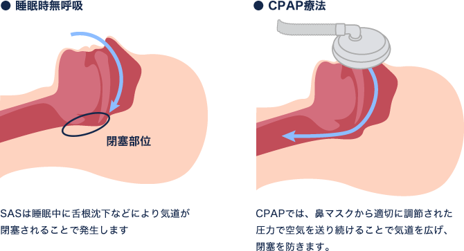 CPAP治療の原理